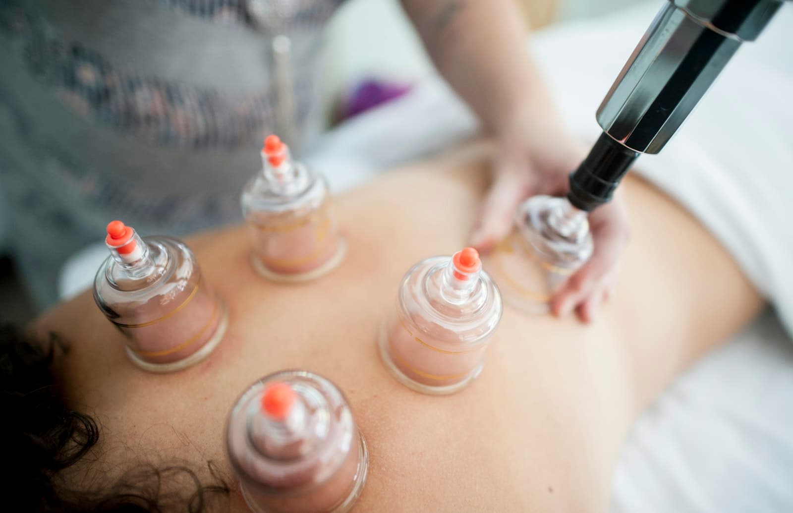Cupping therapy cups applied to the back